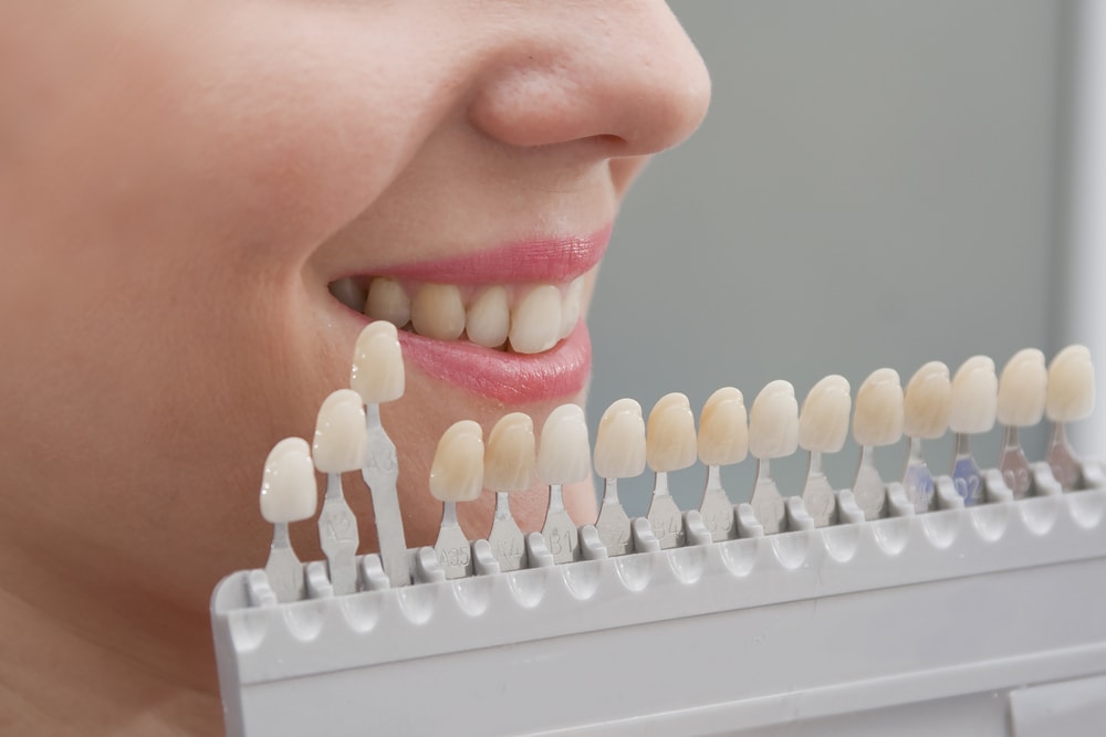 Signs You May Need a Tooth Coloured Filling - Mills Haven Dental